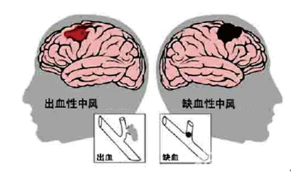  腦卒中-中風-肺病-呼吸肌-血管-呼吸-腦出血