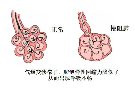 慢阻肺-肺病-慢性-呼吸障礙-咳嗽-咳痰-康復(fù)-肺功能檢測儀